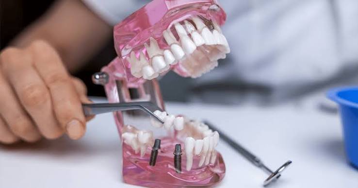 Is Dental Implants Newcastle the Right Choice for You?